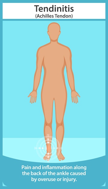 Ilustración de la tendinitis de Aquiles