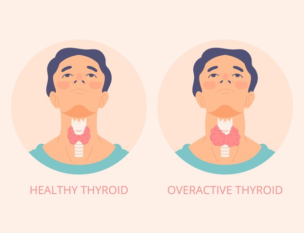 Ilustración de tiroides de diseño plano dibujado a mano