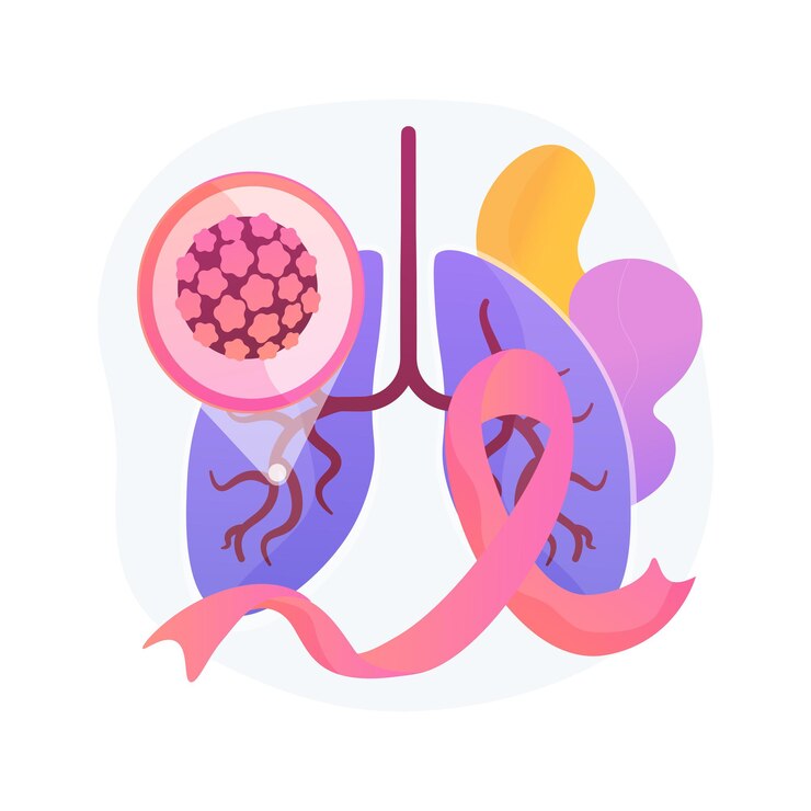 Vector gratuito ilustración de vector de concepto abstracto de cáncer de pulmón. diagnóstico oncológico en etapa temprana, factor de riesgo tumoral, tratamiento del cáncer de pulmón, lucha contra la enfermedad, terapia química, metáfora abstracta de oncología.