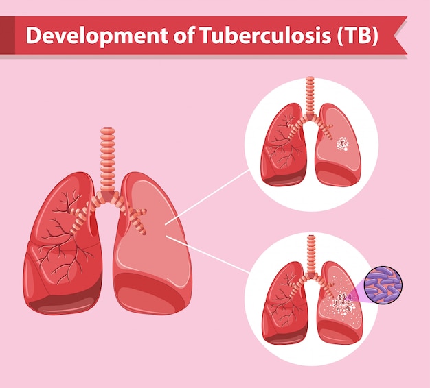 Vector gratuito infografía científica médica de la tuberculosis.