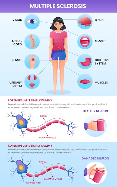 Infografía de esclerosis múltiple en gradiente