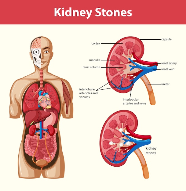 Infografía de estilo de dibujos animados de anatomía de cálculos renales humanos