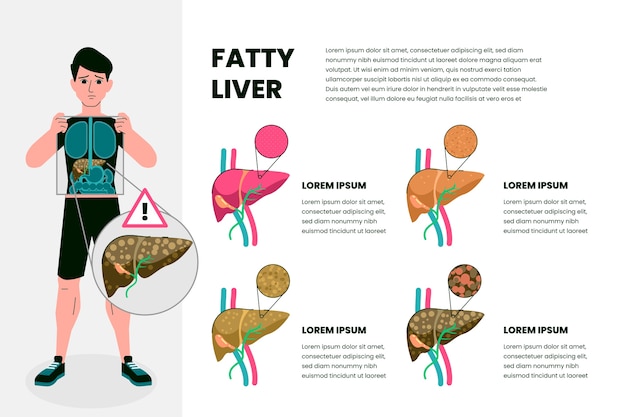 Infografía de hígado graso en diseño plano