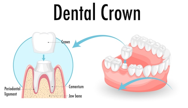 Vector gratuito infografía de humano en corona dental.