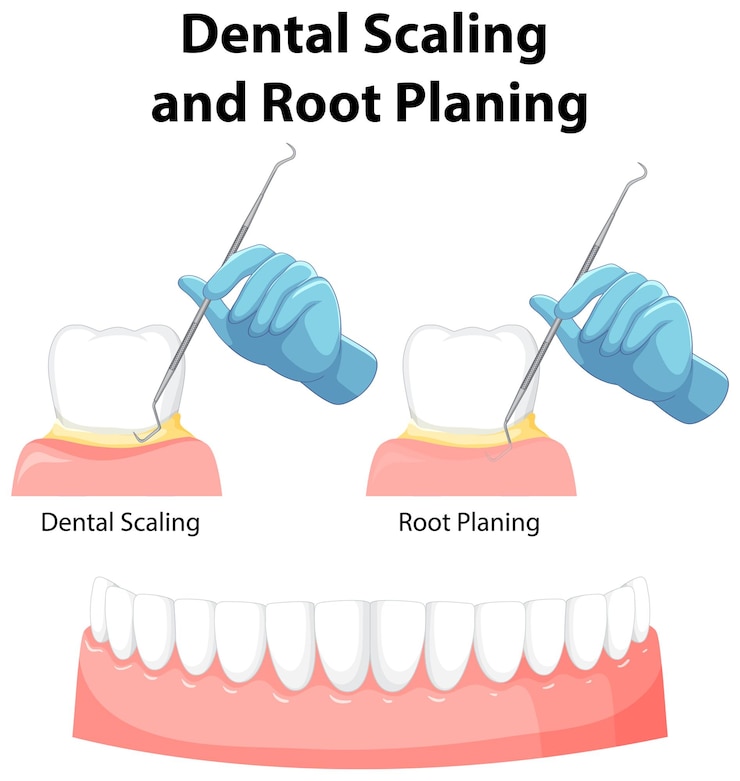 Vector gratuito infografía de humanos en escalado dental y alisado radicular.