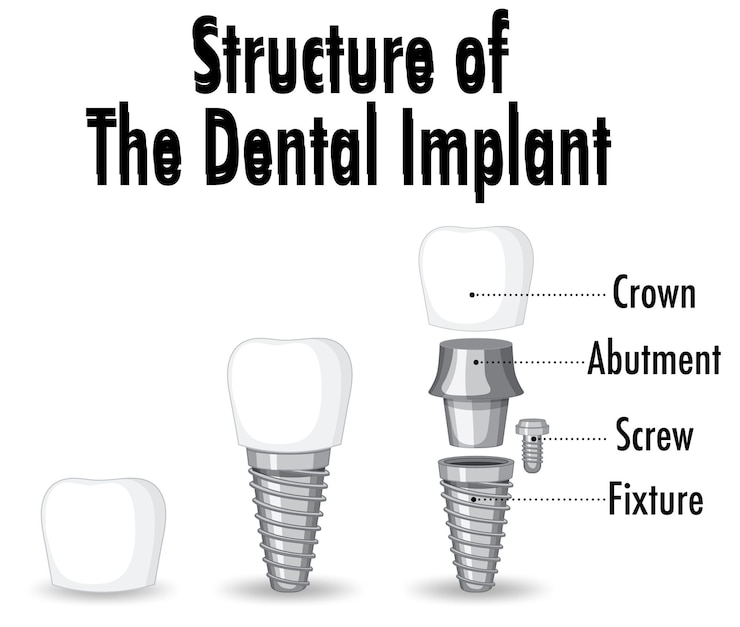 Vector gratuito infografía de humanos en la estructura del implante dental.