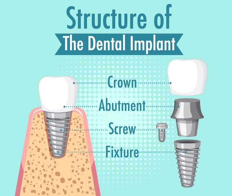 Vector gratuito infografía de humanos en la estructura del implante dental.