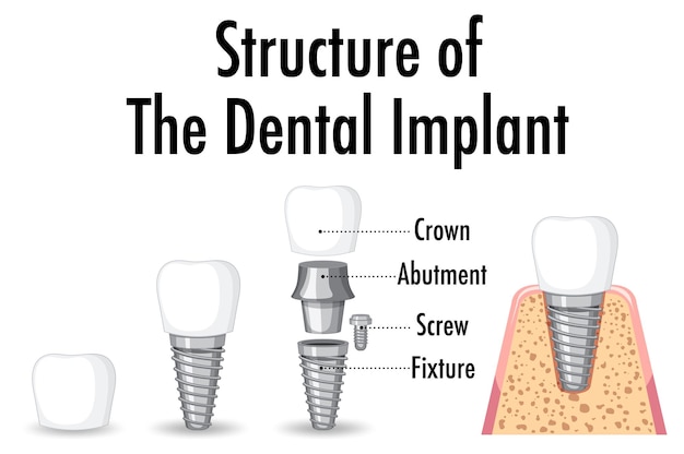 Vector gratuito infografía de humanos en la estructura del implante dental.