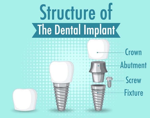 Vector gratuito infografía de humanos en la estructura del implante dental.