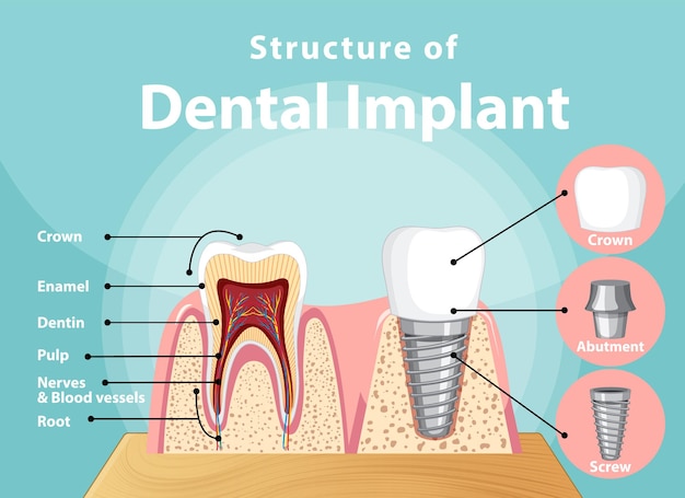 Vector gratuito infografía de humanos en la estructura del implante dental.