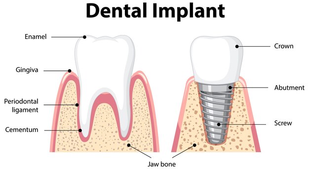 Infografía de humanos en la estructura del implante dental.