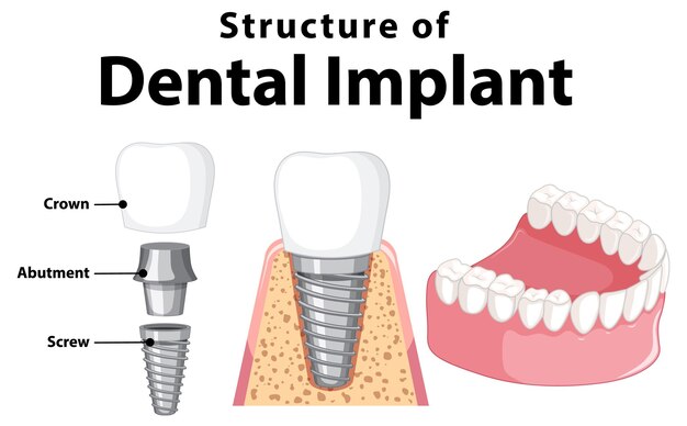 Infografía de humanos en la estructura del implante dental.