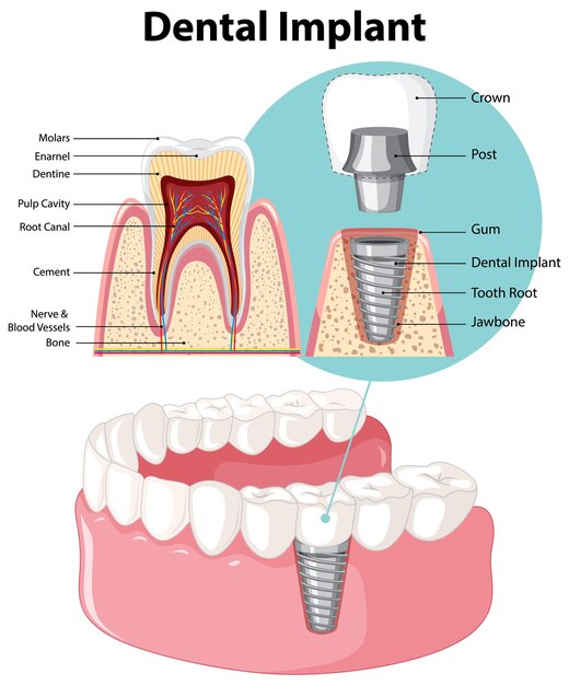 Infografía de humanos en la estructura del implante dental.