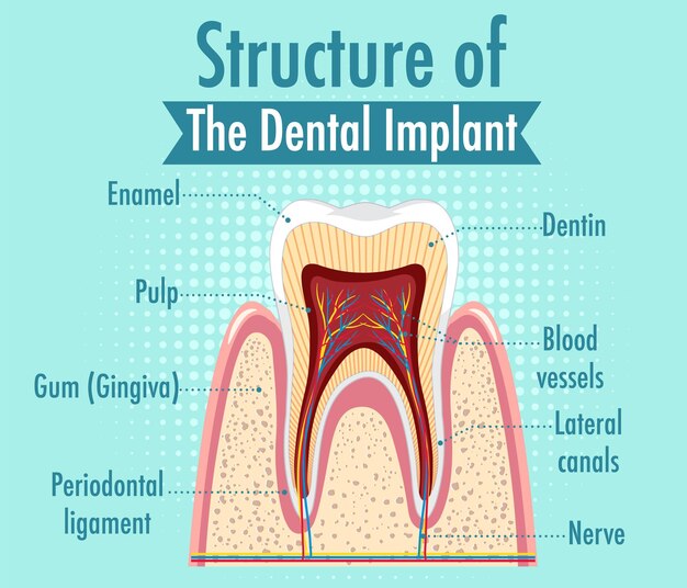 Infografía de humanos en la estructura del implante dental.