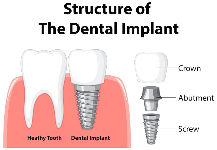 Vector gratuito infografía de humanos en la estructura del implante dental.