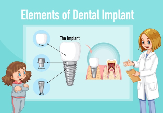 Infografía de humanos en la estructura del implante dental.