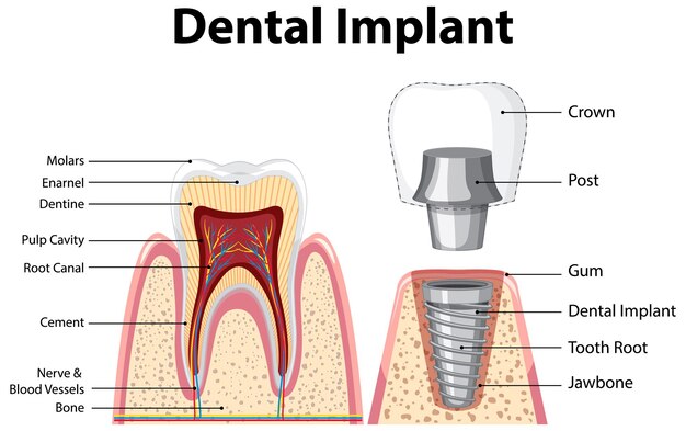 Infografía de humanos en la estructura del implante dental.