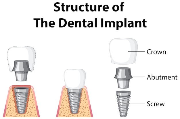 Vector gratuito infografía de humanos en la estructura del implante dental.