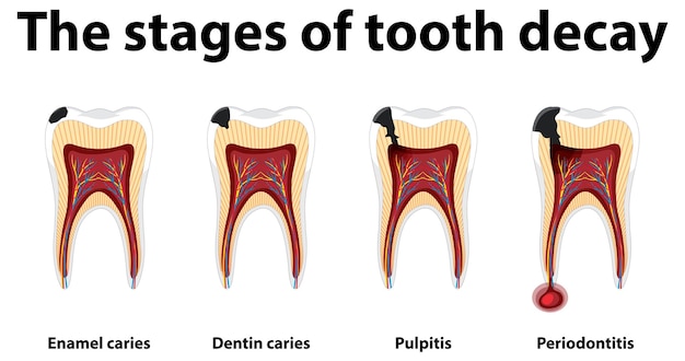 Infografía de humanos en las etapas de la caries dental.