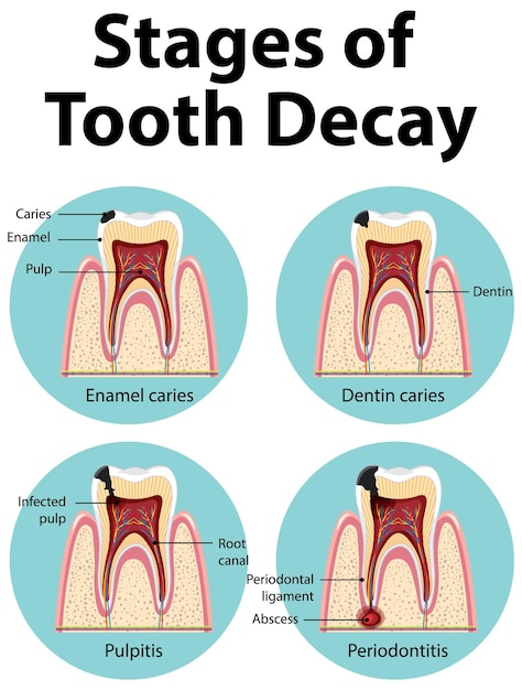 Infografía de humanos en las etapas de la caries dental.