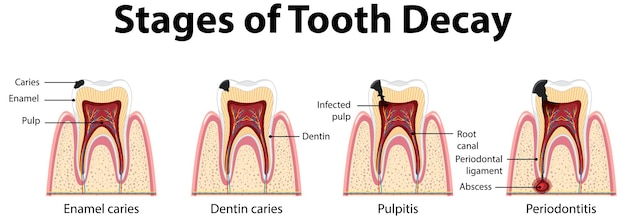 Infografía de humanos en las etapas de la caries dental.