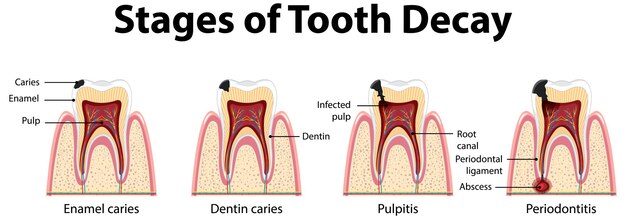 Infografía de humanos en las etapas de la caries dental.