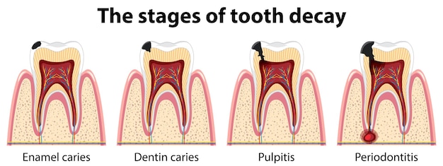 Vector gratuito infografía de humanos en las etapas de la caries dental.