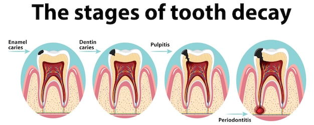 Vector gratuito infografía de humanos en las etapas de la caries dental.