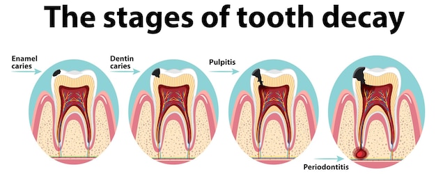 Infografía de humanos en las etapas de la caries dental.