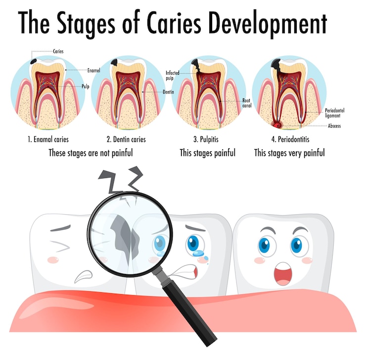 Vector gratuito infografía de humanos en etapas de desarrollo de caries.