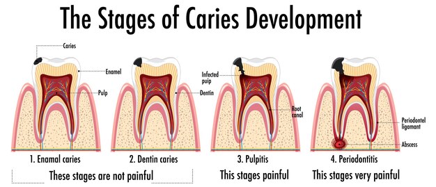 Infografía de humanos en las etapas de desarrollo de caries.