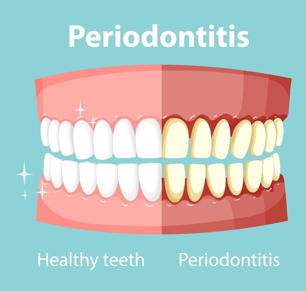 Infografía de humanos en periodontitis.