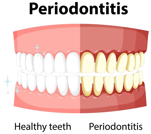 Infografía de humanos en periodontitis.