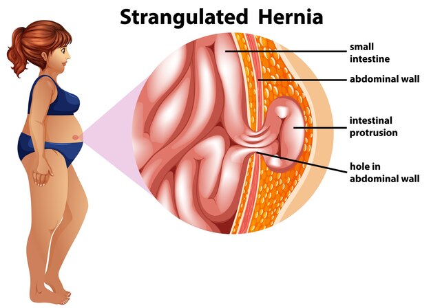 Infografía de información de hernia estrangulada