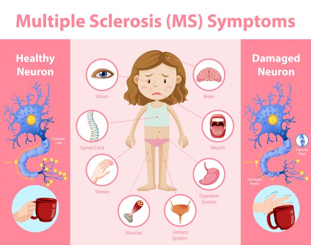 Infografía de información de síntomas de esclerosis múltiple (EM)