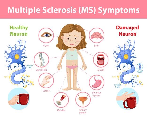 Infografía de información de síntomas de esclerosis múltiple (EM)