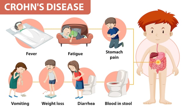 Infografía médica de la enfermedad de crohn