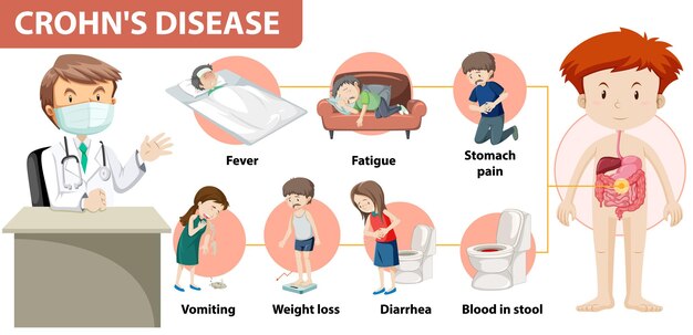 Infografía médica de la enfermedad de Crohn