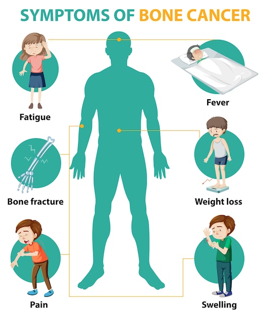 Infografía médica de los síntomas del cáncer de hueso.