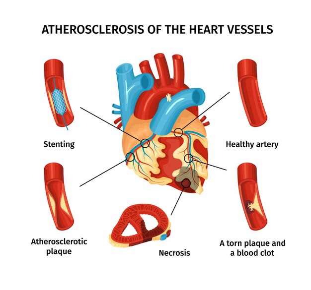 Infografía plana de aterosclerosis de vasos cardíacos con partes etiquetadas