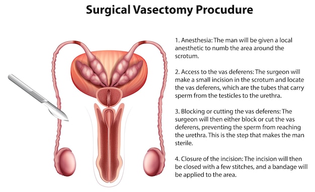 Infografía del procedimiento de vasectomía quirúrgica con explicación