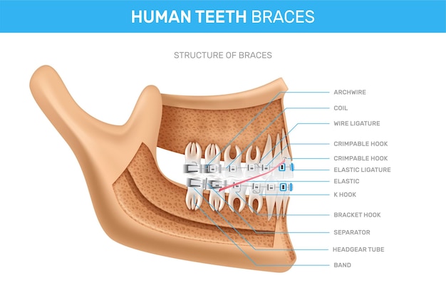 Infografía realista de frenos de dientes humanos