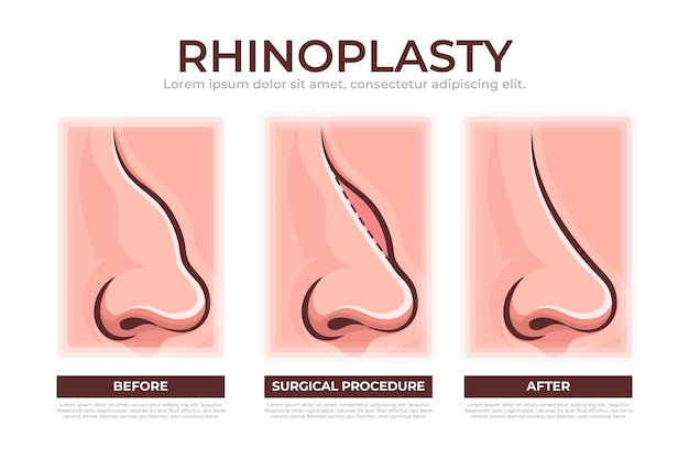 Vector gratuito infografía de rinoplastia dibujada a mano