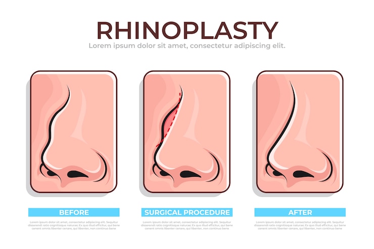 Vector gratuito infografía de rinoplastia dibujada a mano