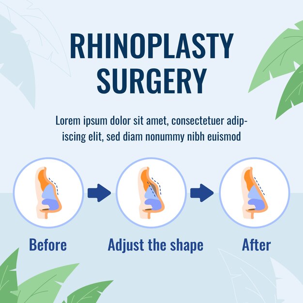 Infografía de rinoplastia de diseño plano dibujado a mano