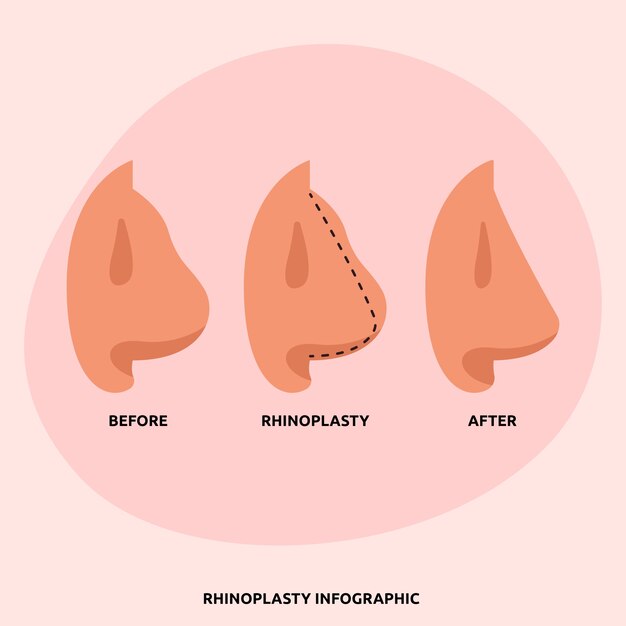 Infografía de rinoplastia de diseño plano dibujado a mano