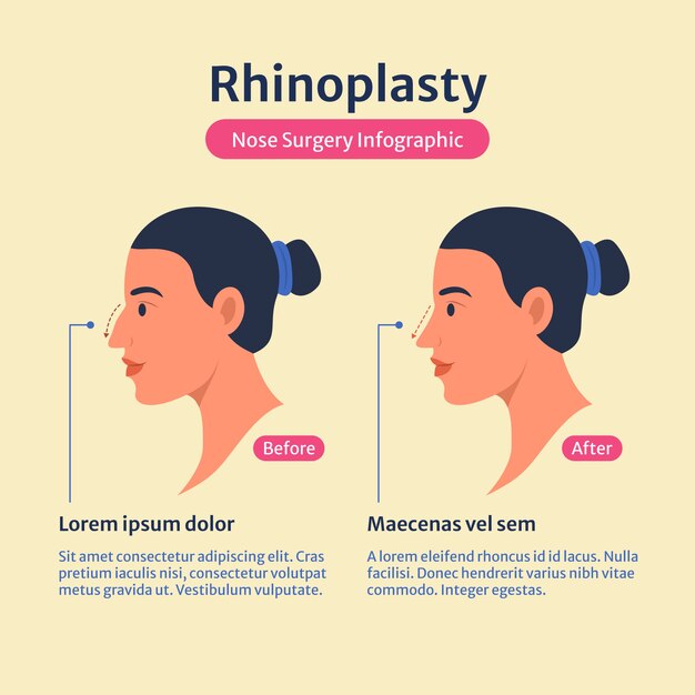 Infografía de rinoplastia de diseño plano dibujado a mano