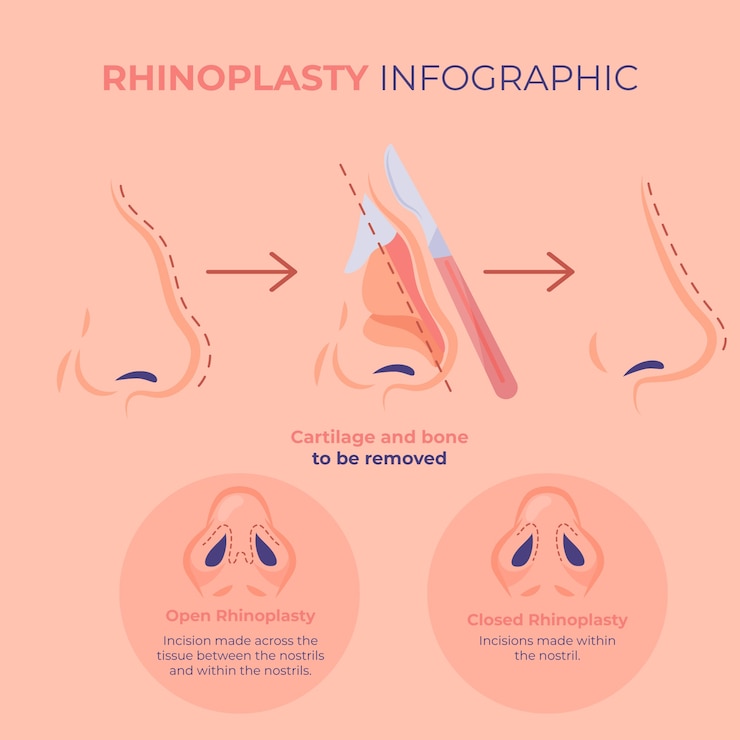 Vector gratuito infografía de rinoplastia de diseño plano dibujado a mano