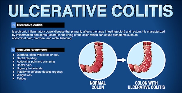 Vector gratuito infografía de los síntomas de la colitis ulcerosa