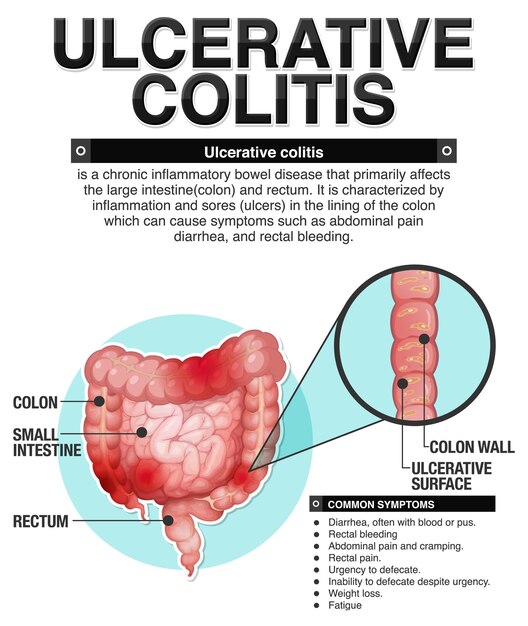 Infografía de los síntomas de la colitis ulcerosa